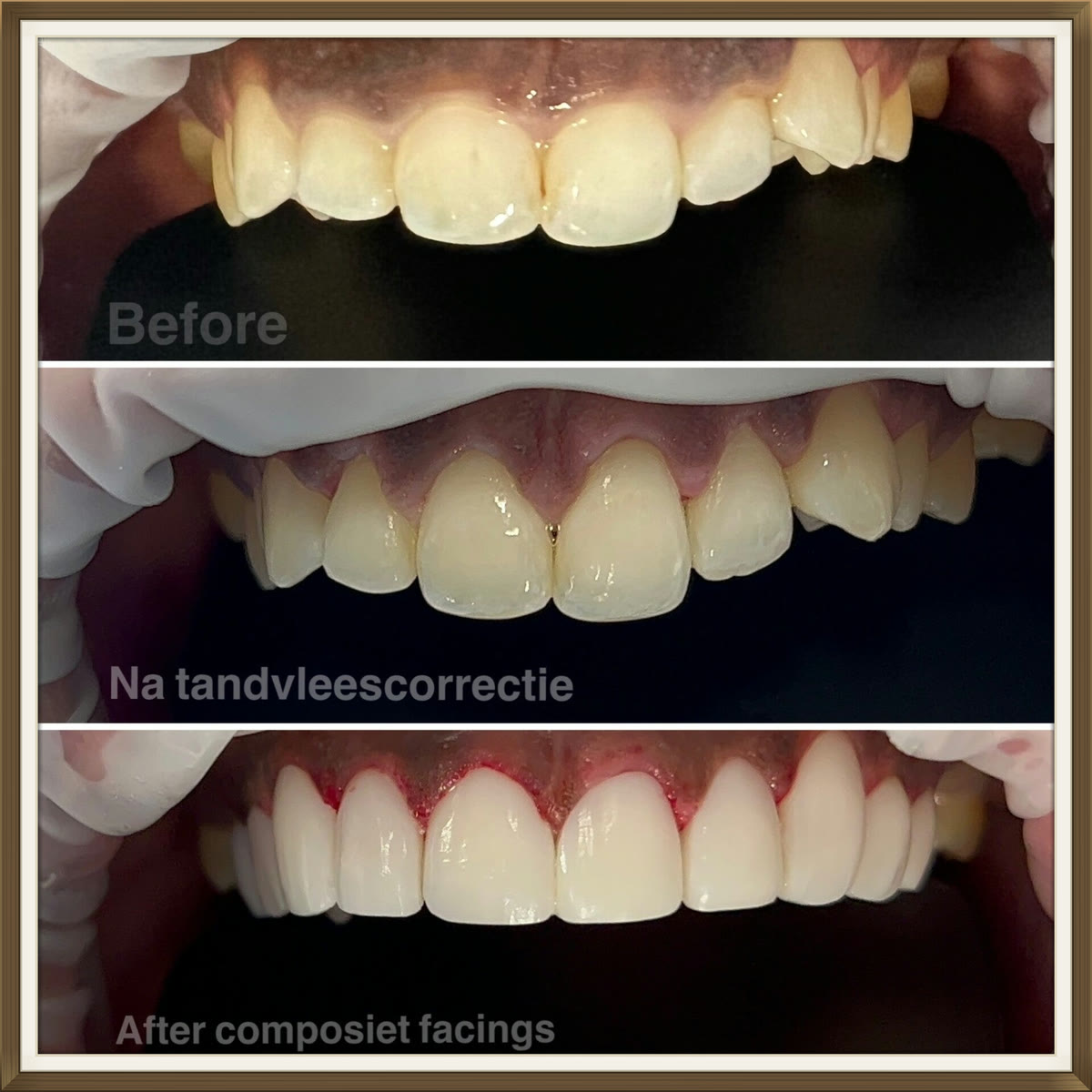 Voor-en-naresultaat van composiet facings, case 2