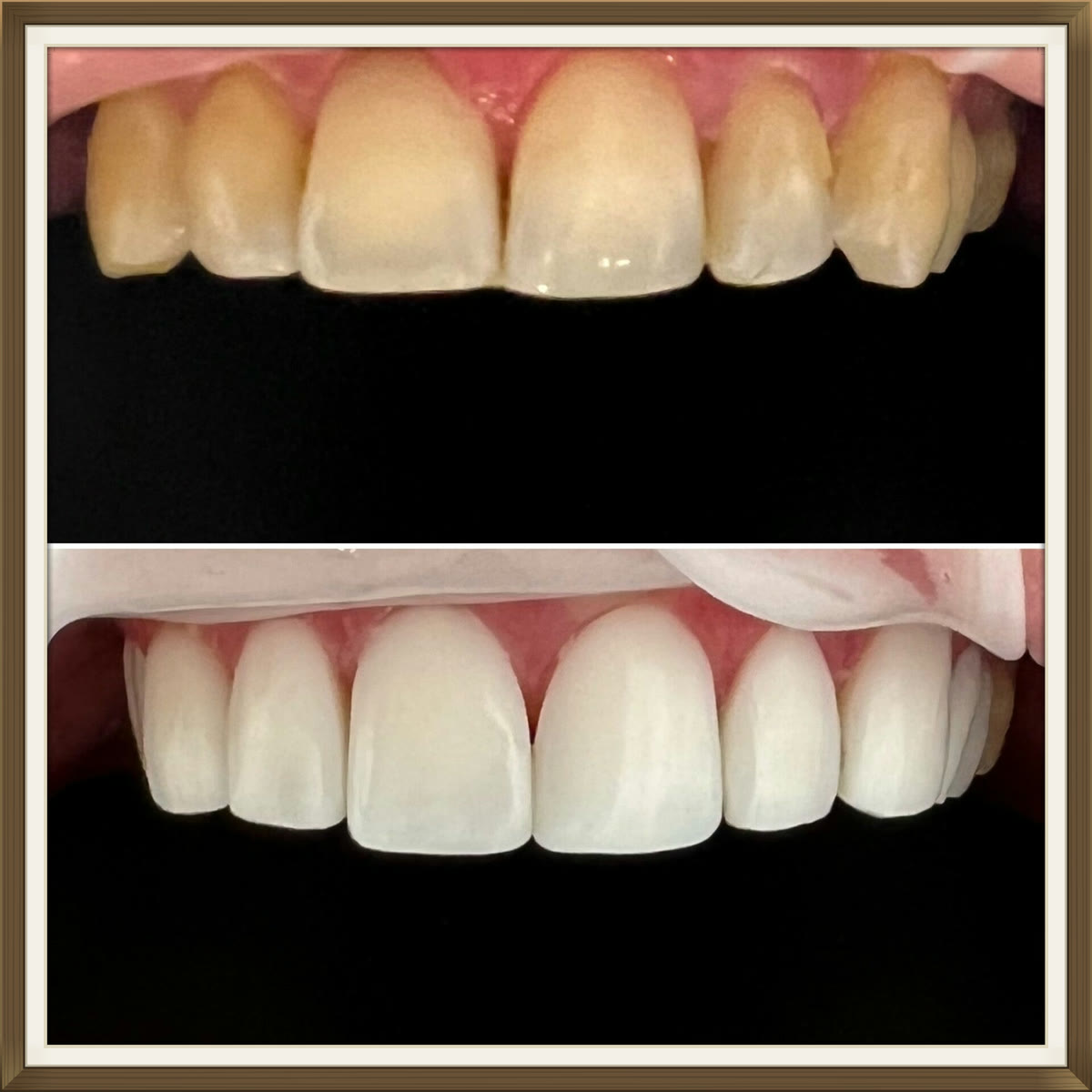 Voor-en-naresultaat van composiet facings, case 4