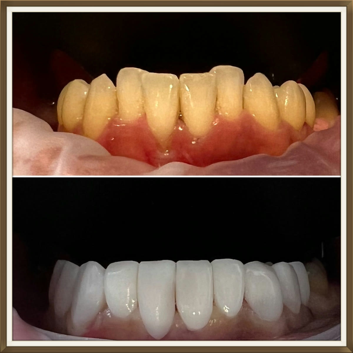 Voor-en-naresultaat van composiet facings, case 6